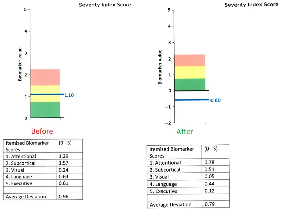 post concussion syndrome cognitive fx result