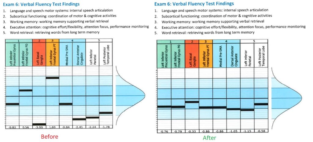 post concussion syndrome cognitive fx result